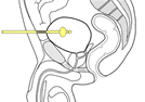 Diagram showing catheter position in bladder.