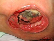 Full blown pressure sore